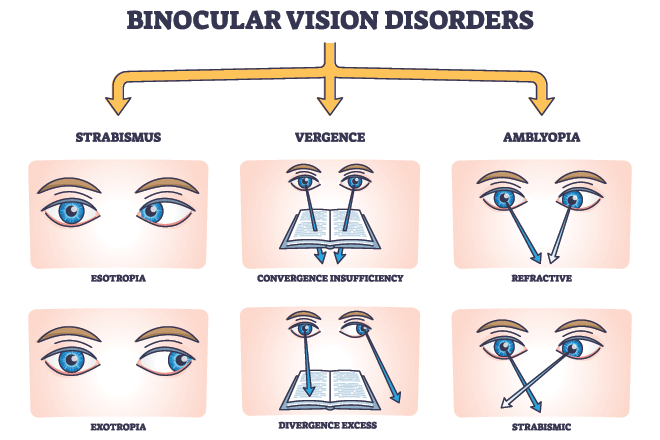 Treating Binocular Vision Dysfunction